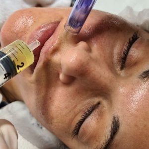 PRX T33+ Mezoterapia mikroigłowa