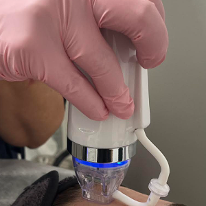 Radiofrekwencja mikroigłowa