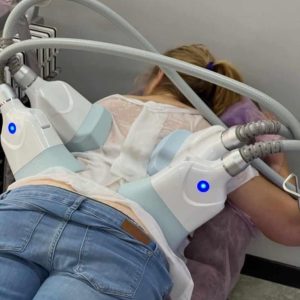 KRIOLIPOLIZA 4D+ Lipoliza termiczna